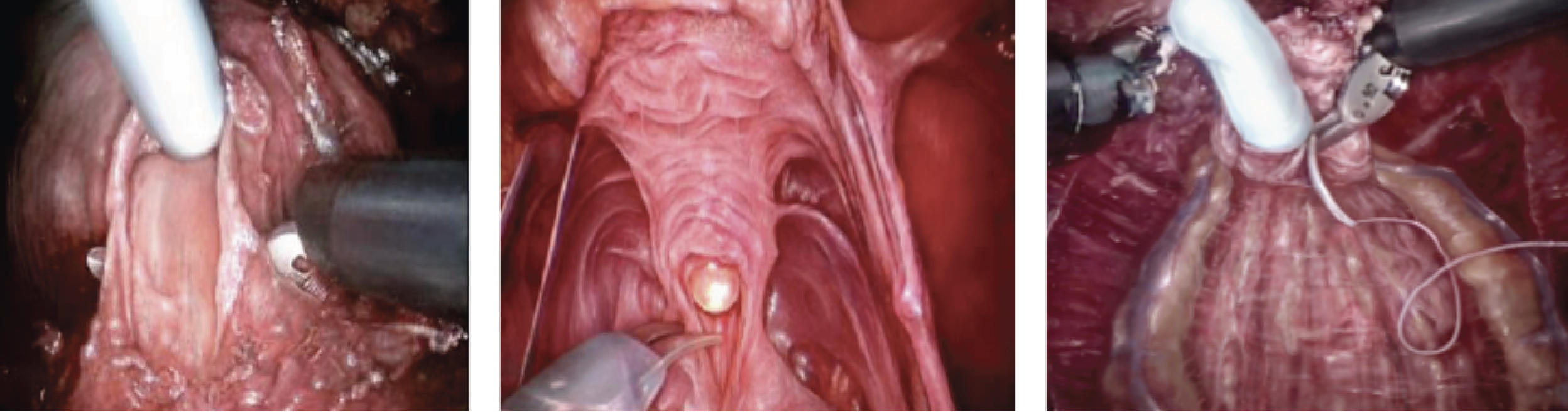 Abbildung 3: Schonende radikale Prostatektomie. Der Blasenhals wird geschont (links), ein kräftiger Harnröhrenstumpf ermöglicht die vollständige Harnkontinenz (mitte), der Erhalt der neurovaskulären Bündel (rechts) ist die Vorraussetzung zum Erhalt der Erektionsfähigkeit.